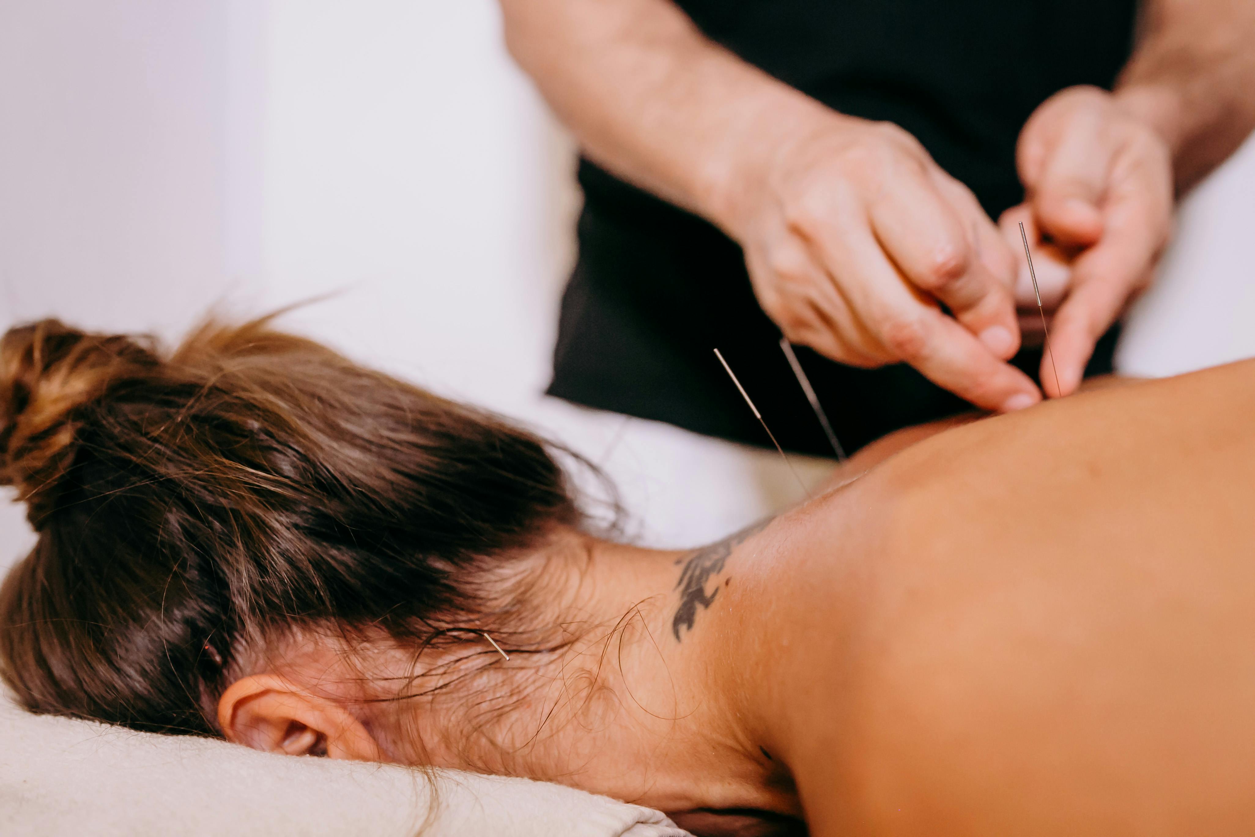 Close-up of acupuncture needles being carefully inserted into a patient's back during a treatment session