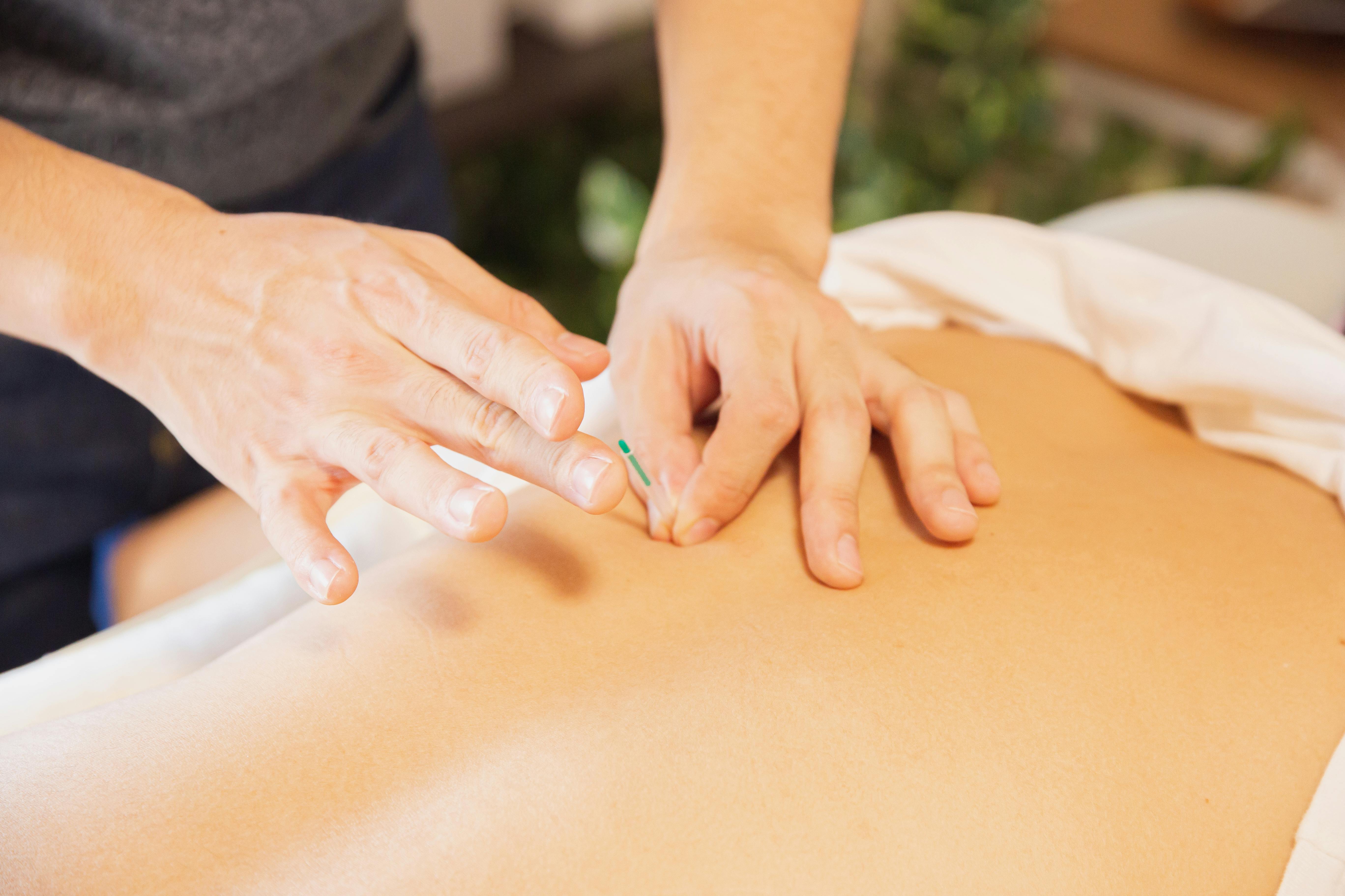 Practitioner carefully applying acupuncture needles to a patient's back